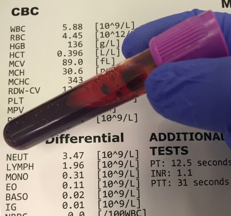 What is a CBC Test e1779957928642